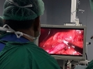Laparoscopic Sleeve Gastrectomy_1