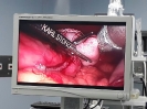 Laparoscopic Sleeve Gastrectomy_3