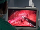 Laparoscopic Sleeve Gastrectomy_5